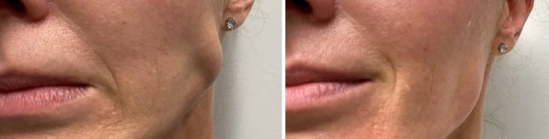 Masseter Hypertrofie Aureus Kliniek