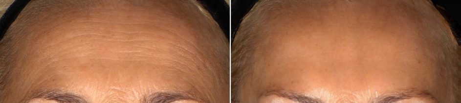 voorhoofd-rimpel-behandeling-vrouw